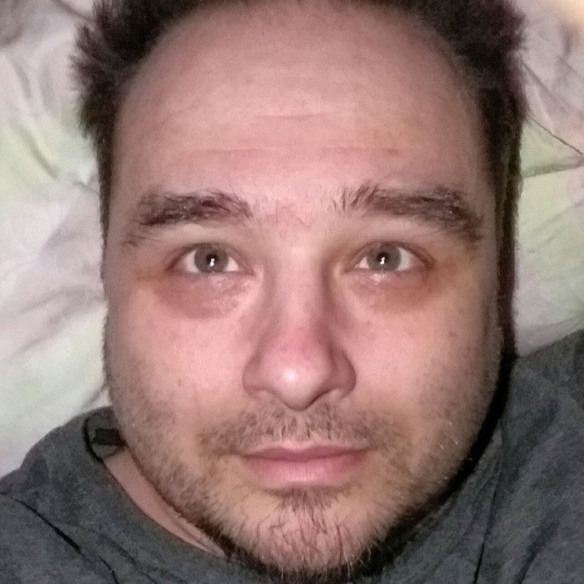 Lékaři v šoku! Muž vyzrál na zelený zákal kapáním bělidla do očí!