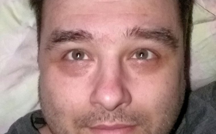 Lékaři v šoku! Muž vyzrál na zelený zákal kapáním bělidla do očí!