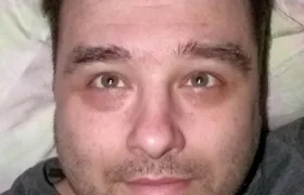Lékaři v šoku! Muž vyzrál na zelený zákal kapáním bělidla do očí!